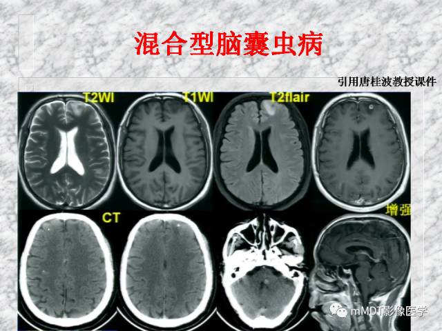 颅内感染性疾病——寄生虫病