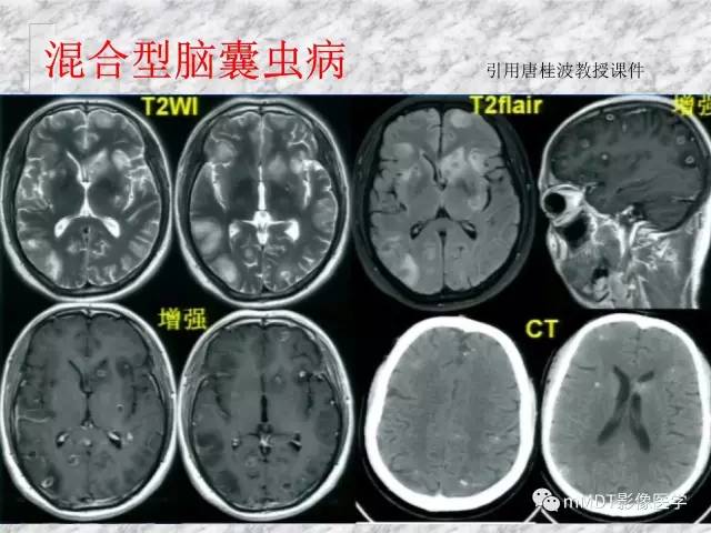 颅内感染性疾病——寄生虫病