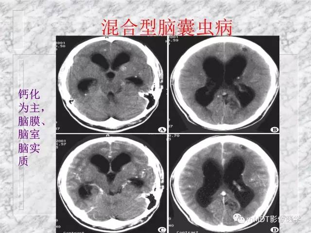 颅内感染性疾病——寄生虫病