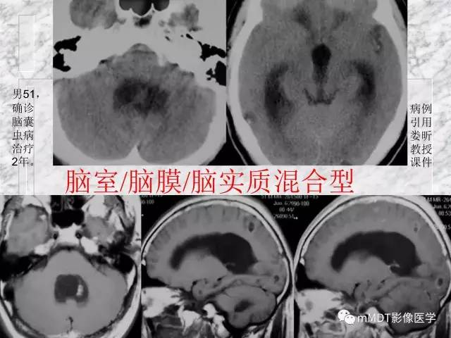 颅内感染性疾病——寄生虫病