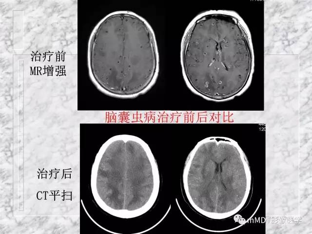 颅内感染性疾病——寄生虫病