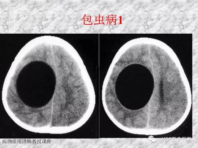 颅内感染性疾病——寄生虫病