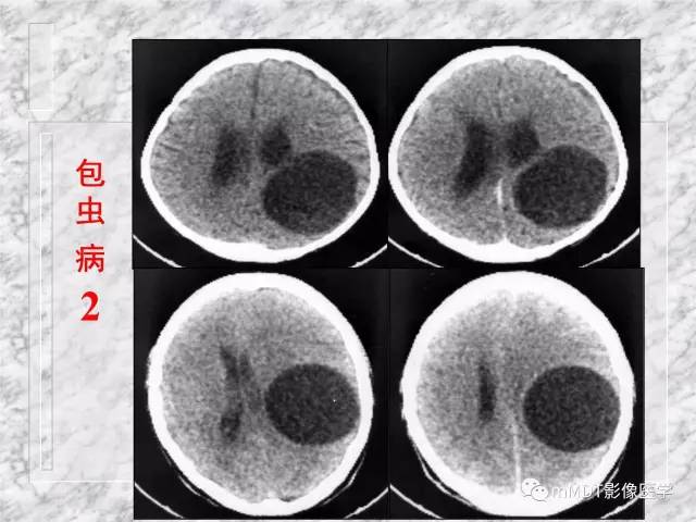 颅内感染性疾病——寄生虫病
