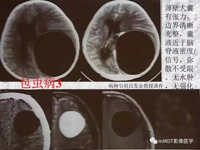 颅内感染性疾病——寄生虫病