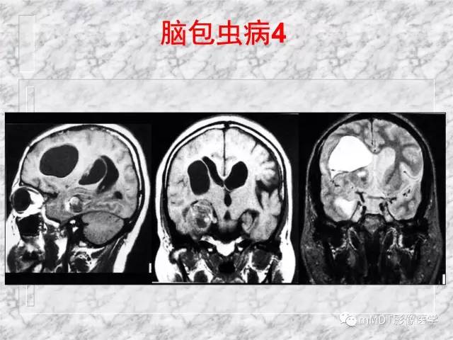 颅内感染性疾病——寄生虫病