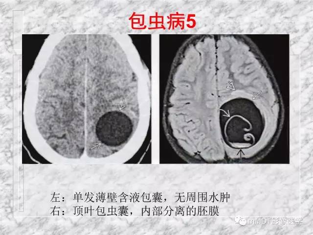颅内感染性疾病——寄生虫病