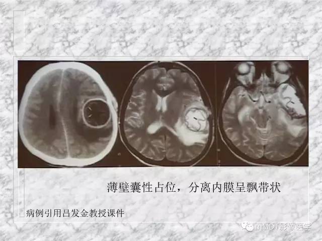 颅内感染性疾病——寄生虫病