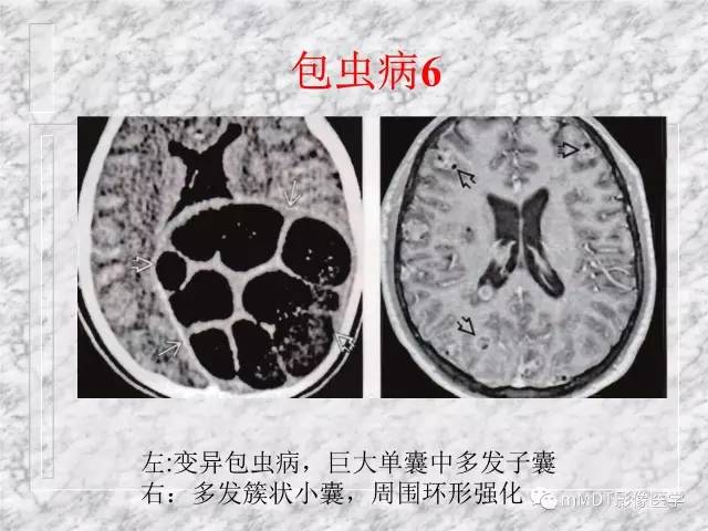 颅内感染性疾病——寄生虫病