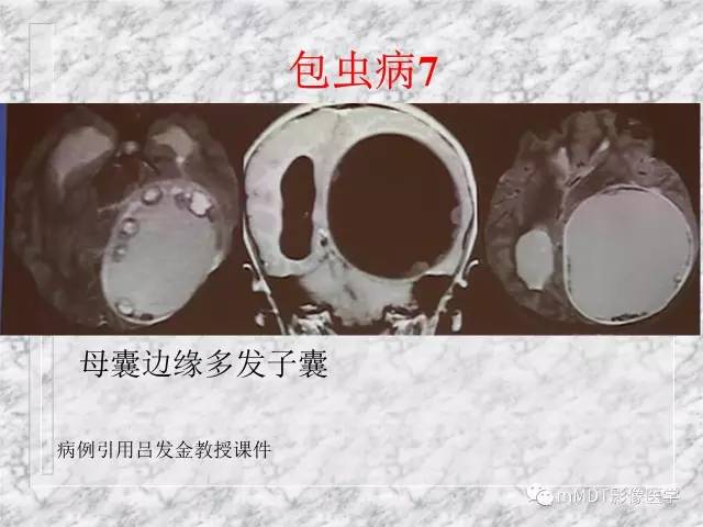 颅内感染性疾病——寄生虫病