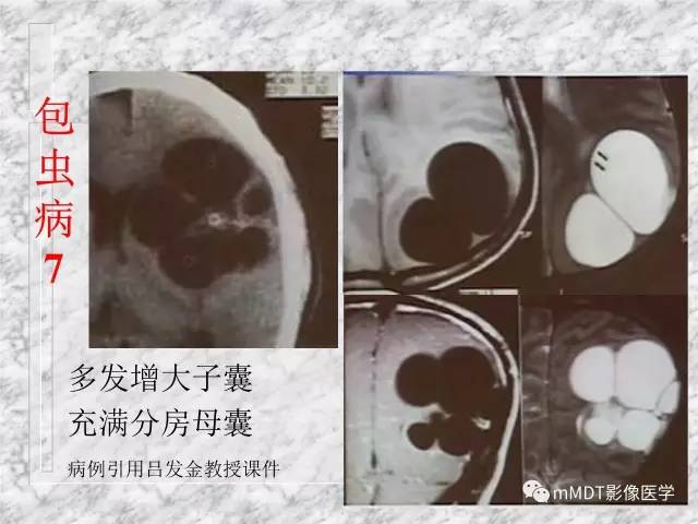 颅内感染性疾病——寄生虫病