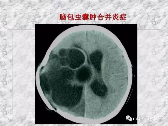 颅内感染性疾病——寄生虫病