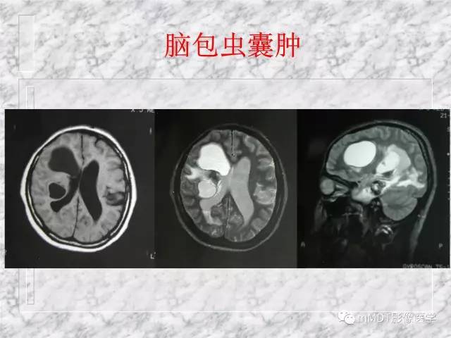 颅内感染性疾病——寄生虫病