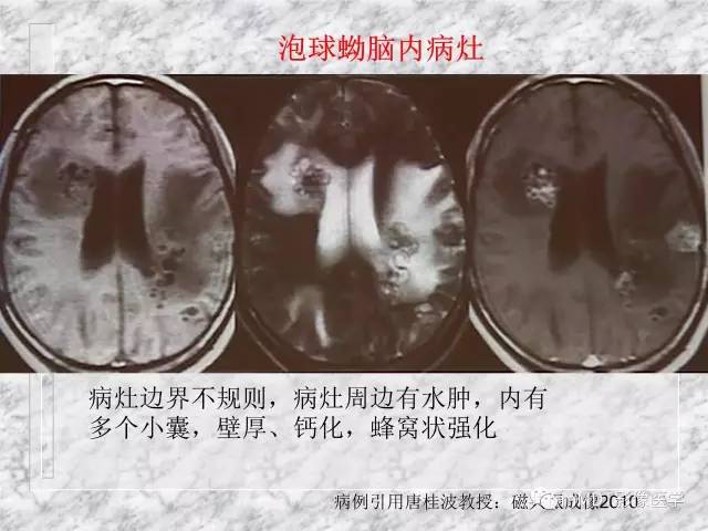 颅内感染性疾病——寄生虫病