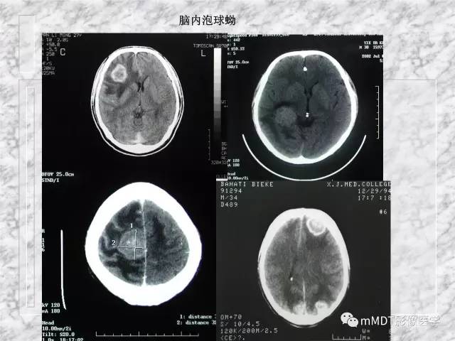 颅内感染性疾病——寄生虫病
