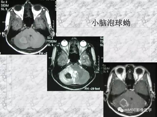 颅内感染性疾病——寄生虫病