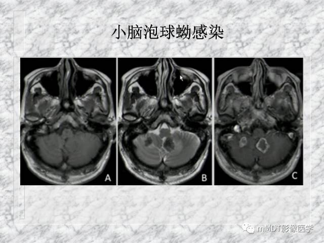 颅内感染性疾病——寄生虫病