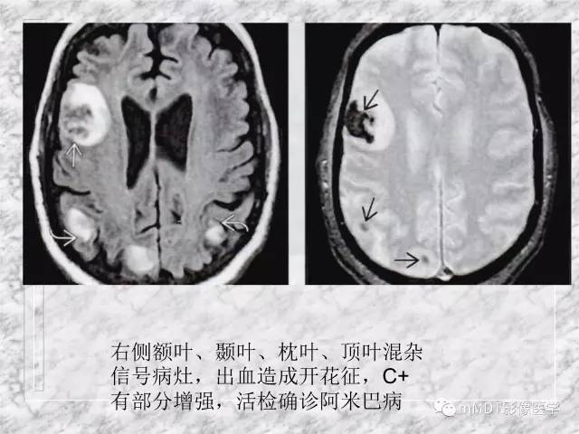 颅内感染性疾病——寄生虫病