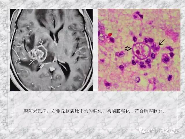 颅内感染性疾病——寄生虫病