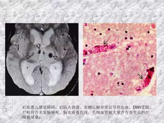 颅内感染性疾病——寄生虫病