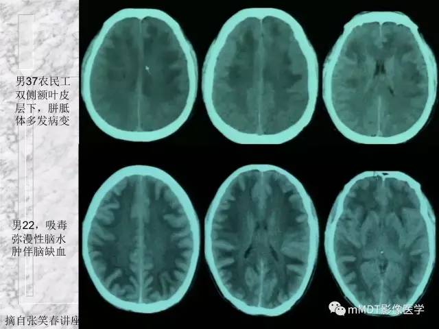 颅内感染性疾病——寄生虫病
