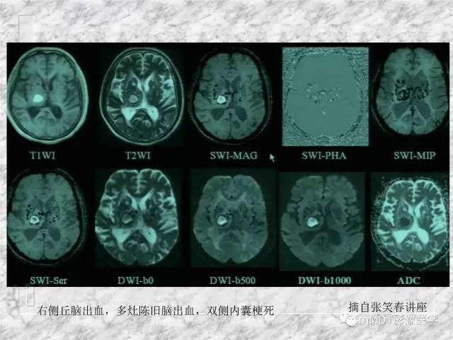颅内感染性疾病——寄生虫病
