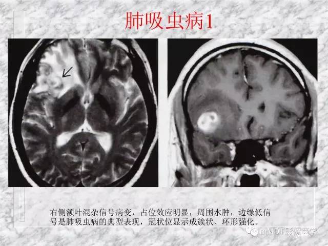 颅内感染性疾病——寄生虫病
