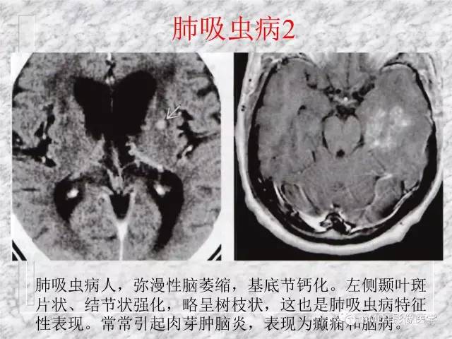 颅内感染性疾病——寄生虫病