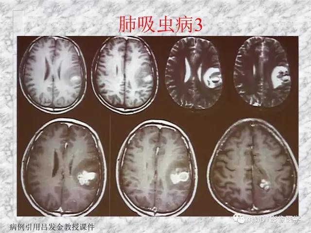 颅内感染性疾病——寄生虫病