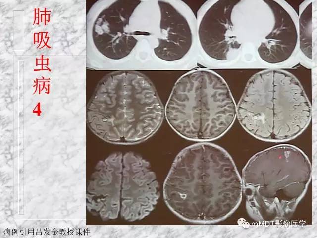 颅内感染性疾病——寄生虫病