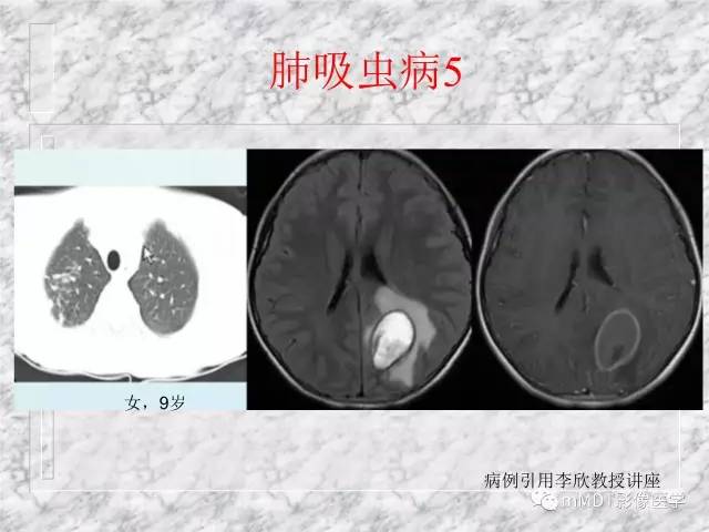 颅内感染性疾病——寄生虫病