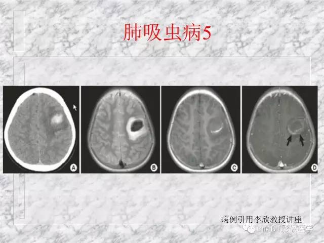 颅内感染性疾病——寄生虫病