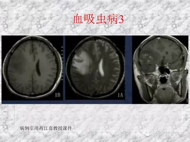 颅内感染性疾病——寄生虫病