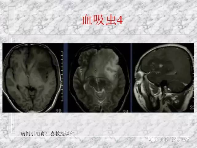 颅内感染性疾病——寄生虫病