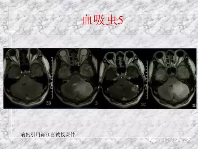 颅内感染性疾病——寄生虫病