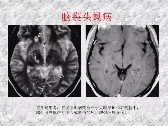 颅内感染性疾病——寄生虫病