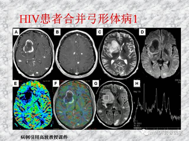 颅内感染性疾病——寄生虫病