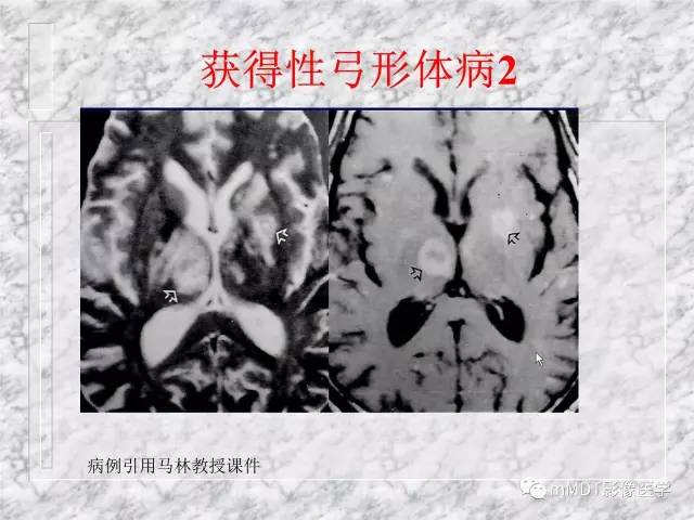颅内感染性疾病——寄生虫病