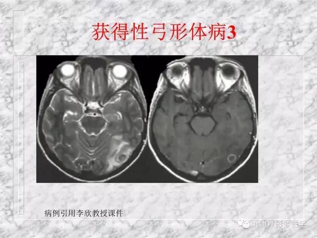 颅内感染性疾病——寄生虫病