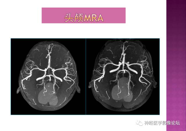 【病例】表皮样囊肿1例MR影像表现