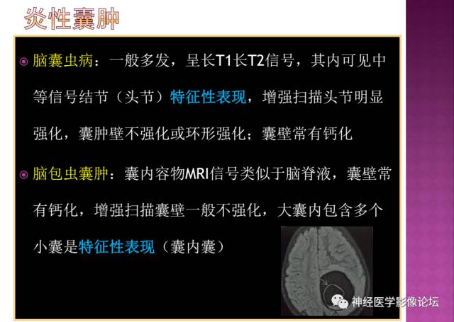【病例】表皮样囊肿1例MR影像表现
