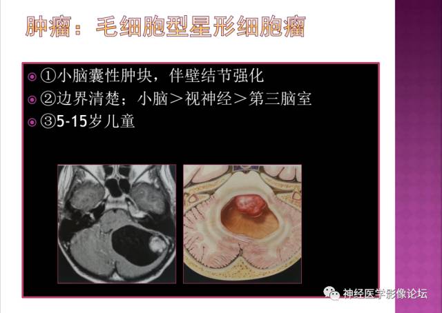 【病例】表皮样囊肿1例MR影像表现