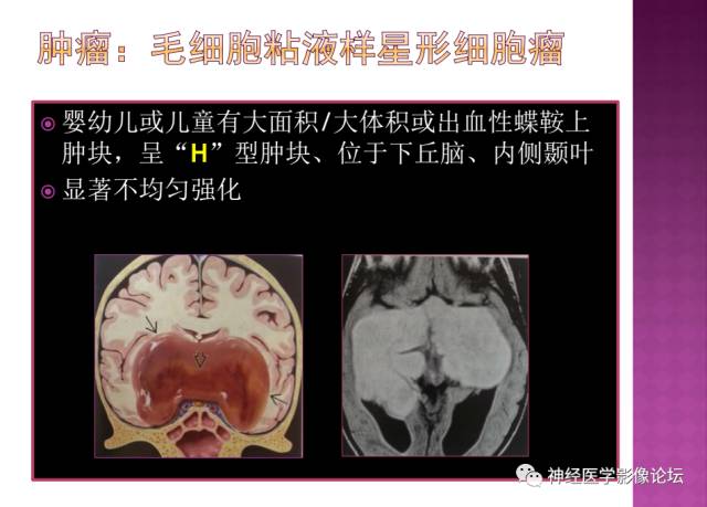【病例】表皮样囊肿1例MR影像表现