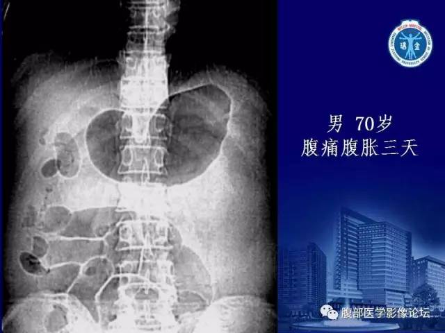 【PPT】急性肠系膜血管梗塞CT诊断