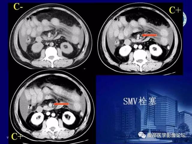 【PPT】急性肠系膜血管梗塞CT诊断