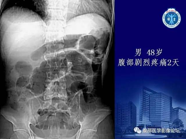 【PPT】急性肠系膜血管梗塞CT诊断