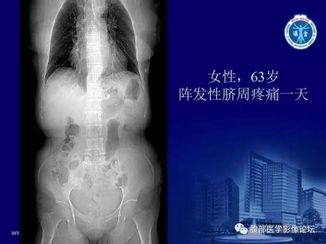 【PPT】急性肠系膜血管梗塞CT诊断