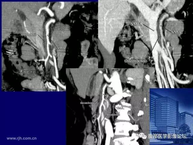 【PPT】急性肠系膜血管梗塞CT诊断