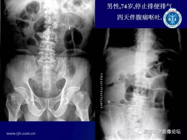 【PPT】急性肠系膜血管梗塞CT诊断