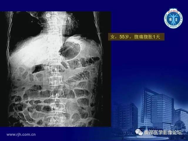 【PPT】急性肠系膜血管梗塞CT诊断