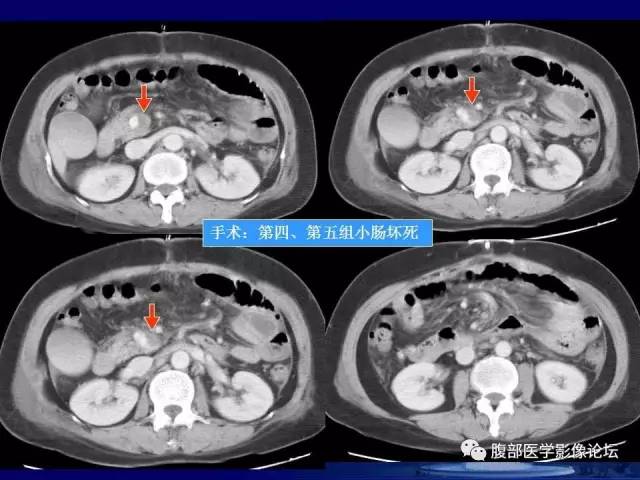 【PPT】急性肠系膜血管梗塞CT诊断